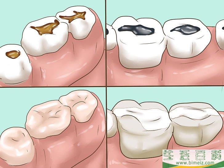 怎么判断自己的补牙材料是否需要更换