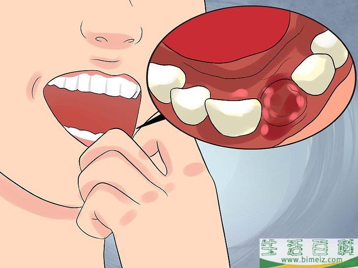 怎么在拔牙后促进牙龈伤口愈合