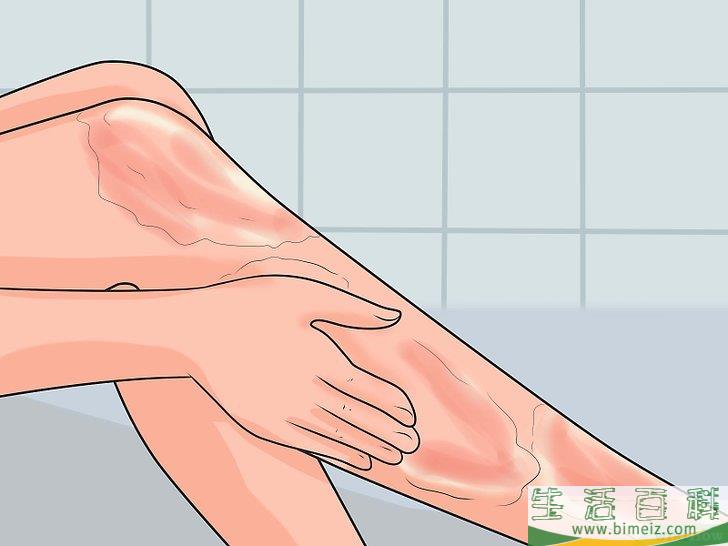 怎么治疗被热水烫伤的皮肤