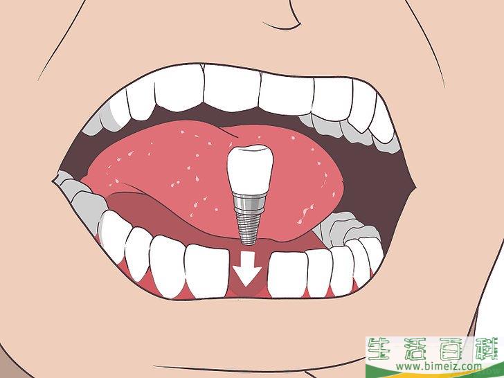 怎么防止蛀牙恶化