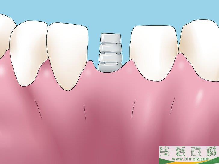 怎么修复牙骨质流失