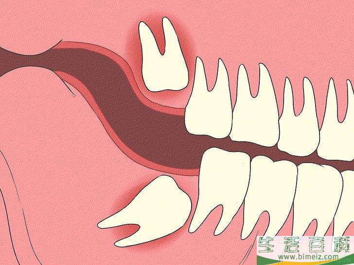 怎么区分萌生智齿和阻生智齿