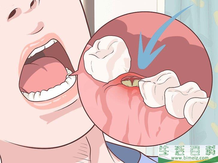 怎么在拔牙后促进牙龈伤口愈合