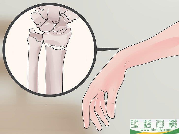 怎么辨别手腕扭伤和手腕骨折